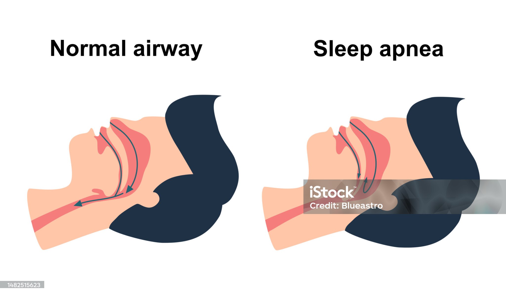 Obstructive sleep apnea syndrome concept vector illustration.
