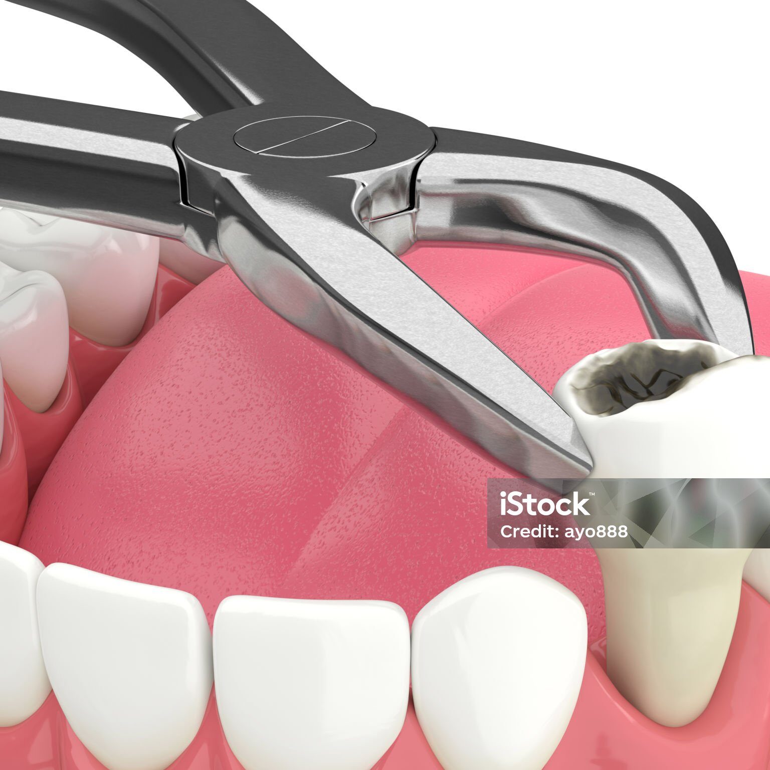 3d render of lower jaw with tooth extracted by dental forceps