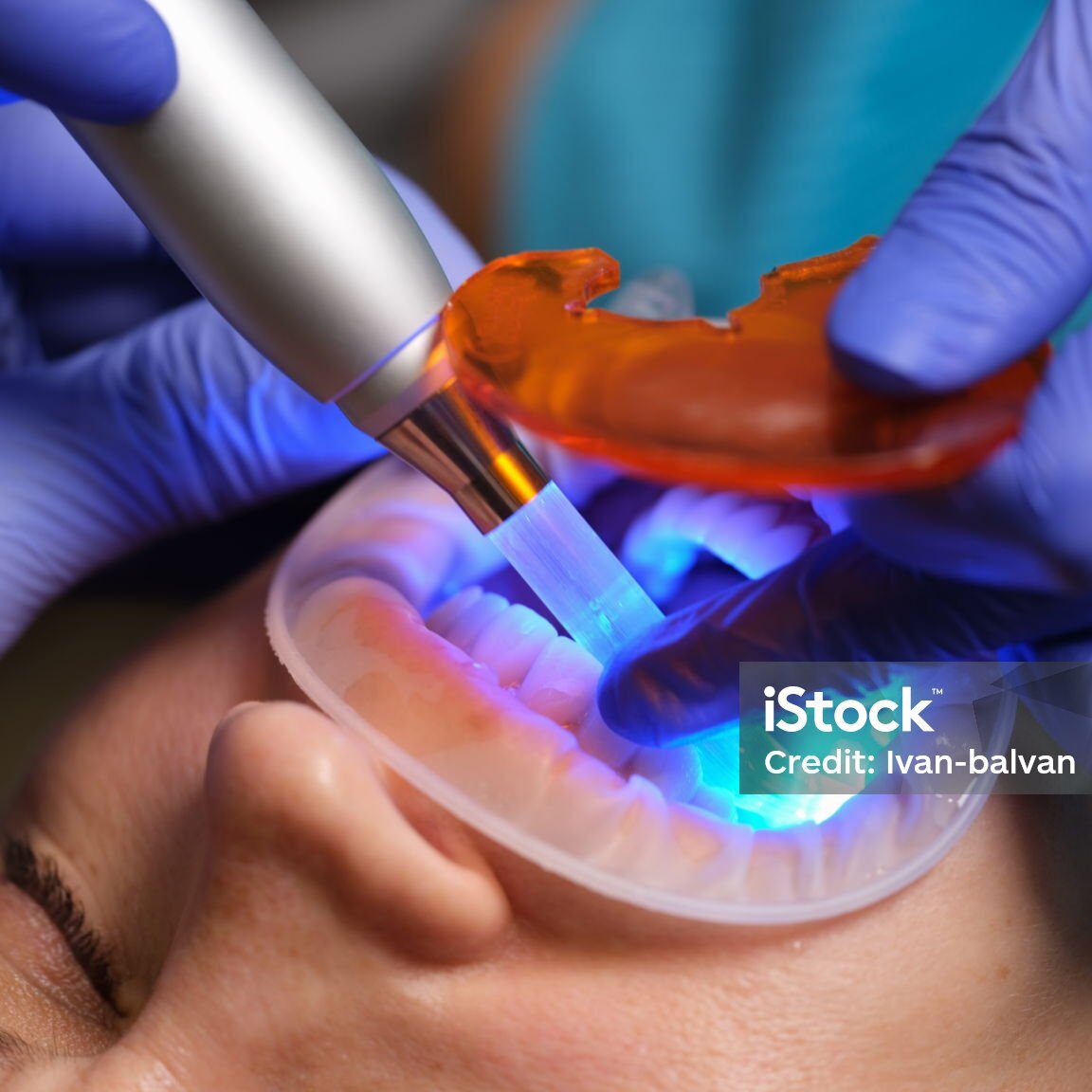 Restoration of teeth with filling-polymerization lamp. Dental light-curing composite resin