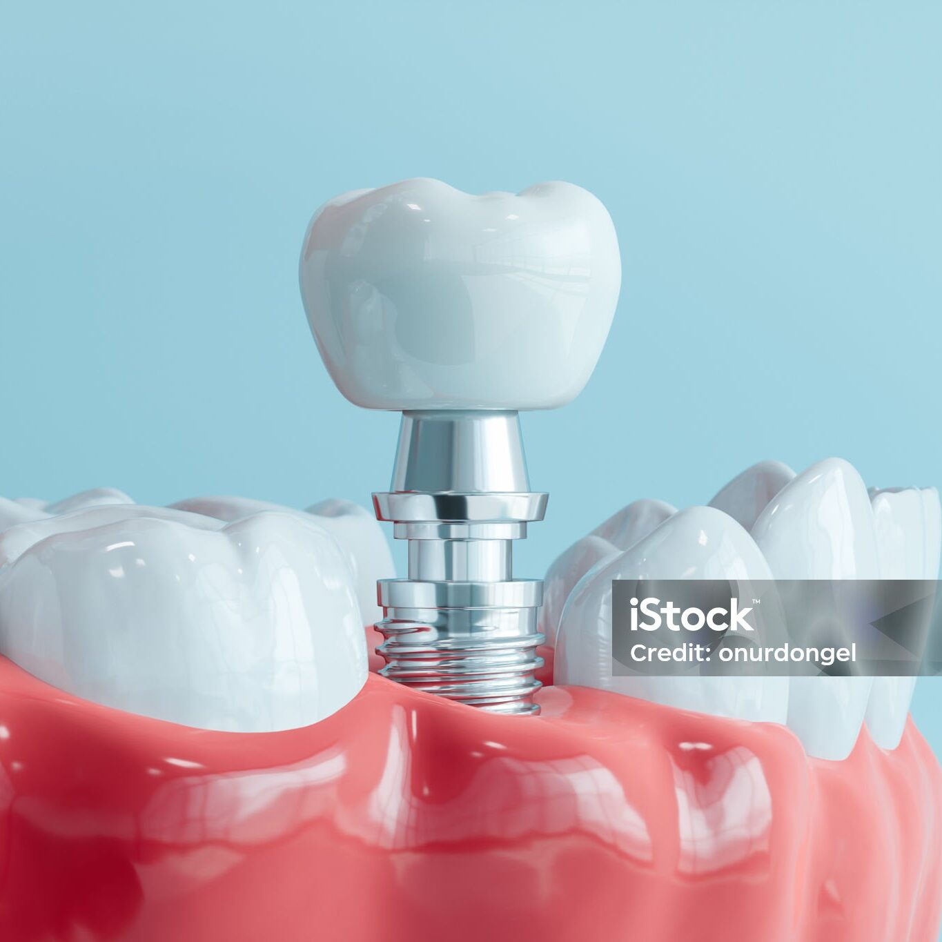 3D Model Of Human Gums And Dental Implant With Blue Background
