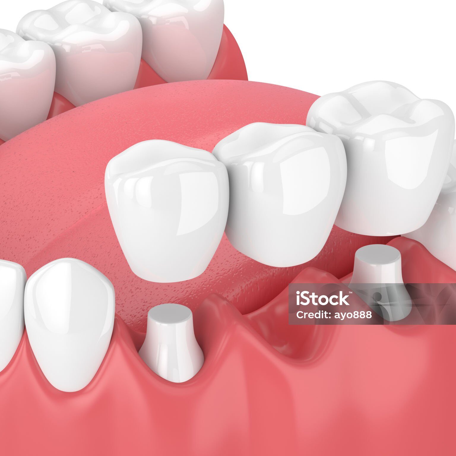 3d render of jaw with dental bridge  over white background